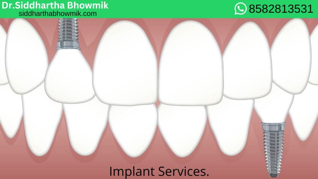 dental Implant Services by Dr. Siddhartha Bhowmik. best dental and oral surgeon in kolkata.